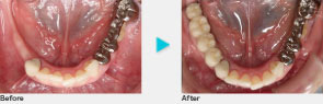 奥歯下のインプラント症例