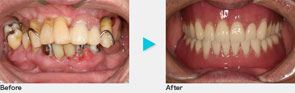 インプラントで入れ歯を固定する症例