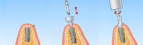 奥歯へのインプラント手術手順