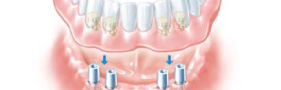 義歯／入れ歯を固定する治療
